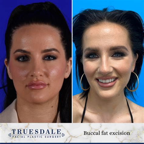 buccal fat removal phoenix|Top Buccal Fat Removal Scottsdale, Tempe, Mesa, AZ .